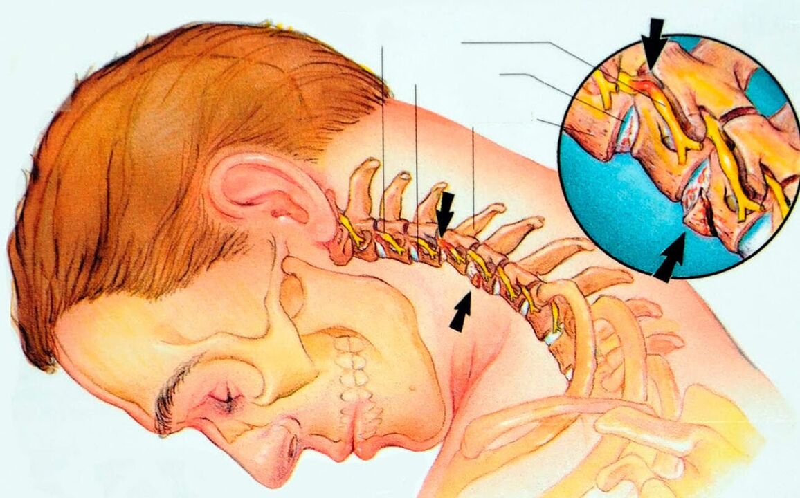 что такое шейный остеохондроз
