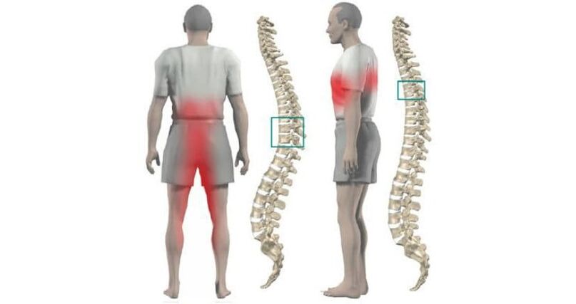 боль в теле и позвоночнике при остеохондрозе
